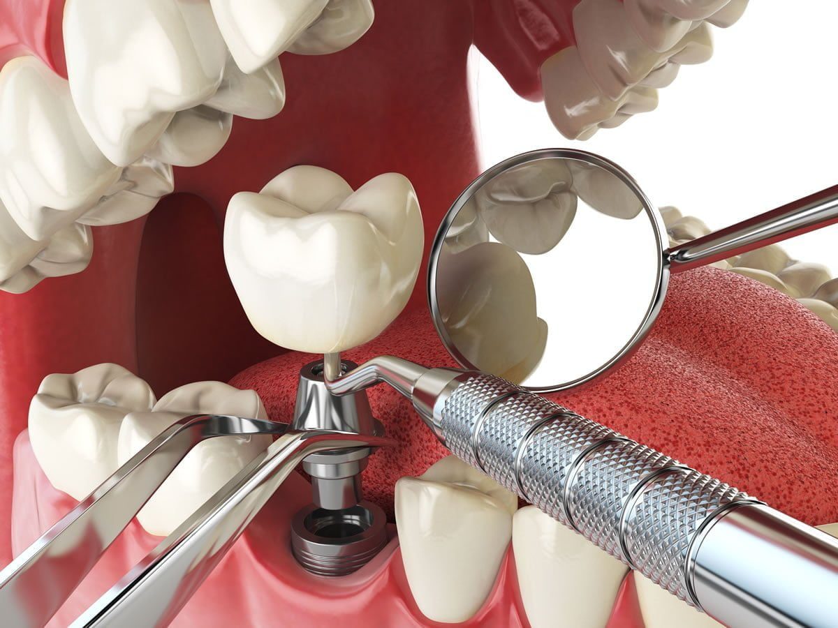 De ce sa optezi pentru un implant dentar?