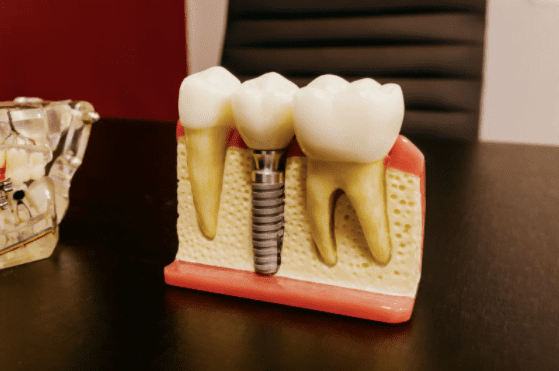 Implant dentar într-o singură zi?