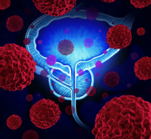 Cancerul de prostata poate fi prevenit?