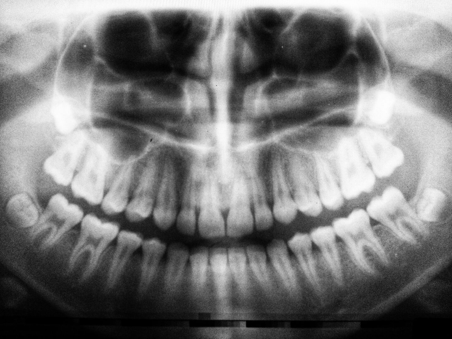 Eroziunea dentara – cum sa o recunosti si sa o previi