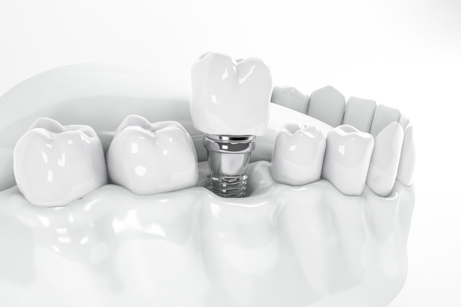 Implantul Dentar: Soluția Modernă pentru Înlocuirea Dinților Pierduți