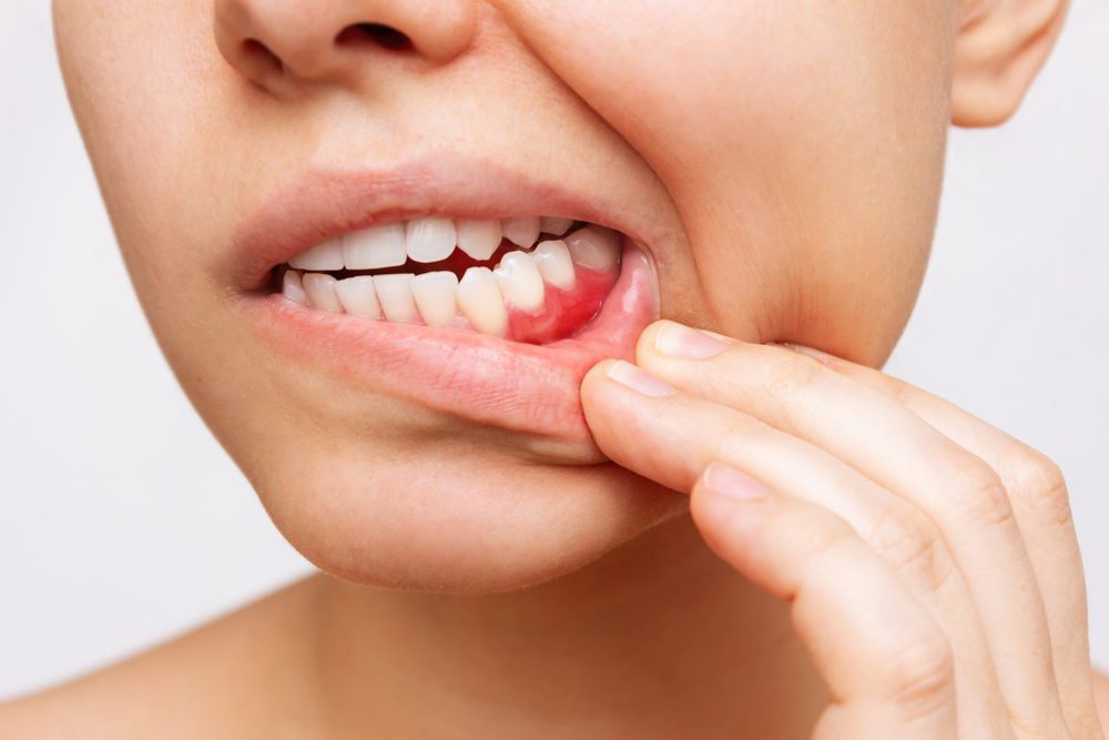 Prevenirea parodontozei: 5 recomandări pentru o sănătate orală optimă